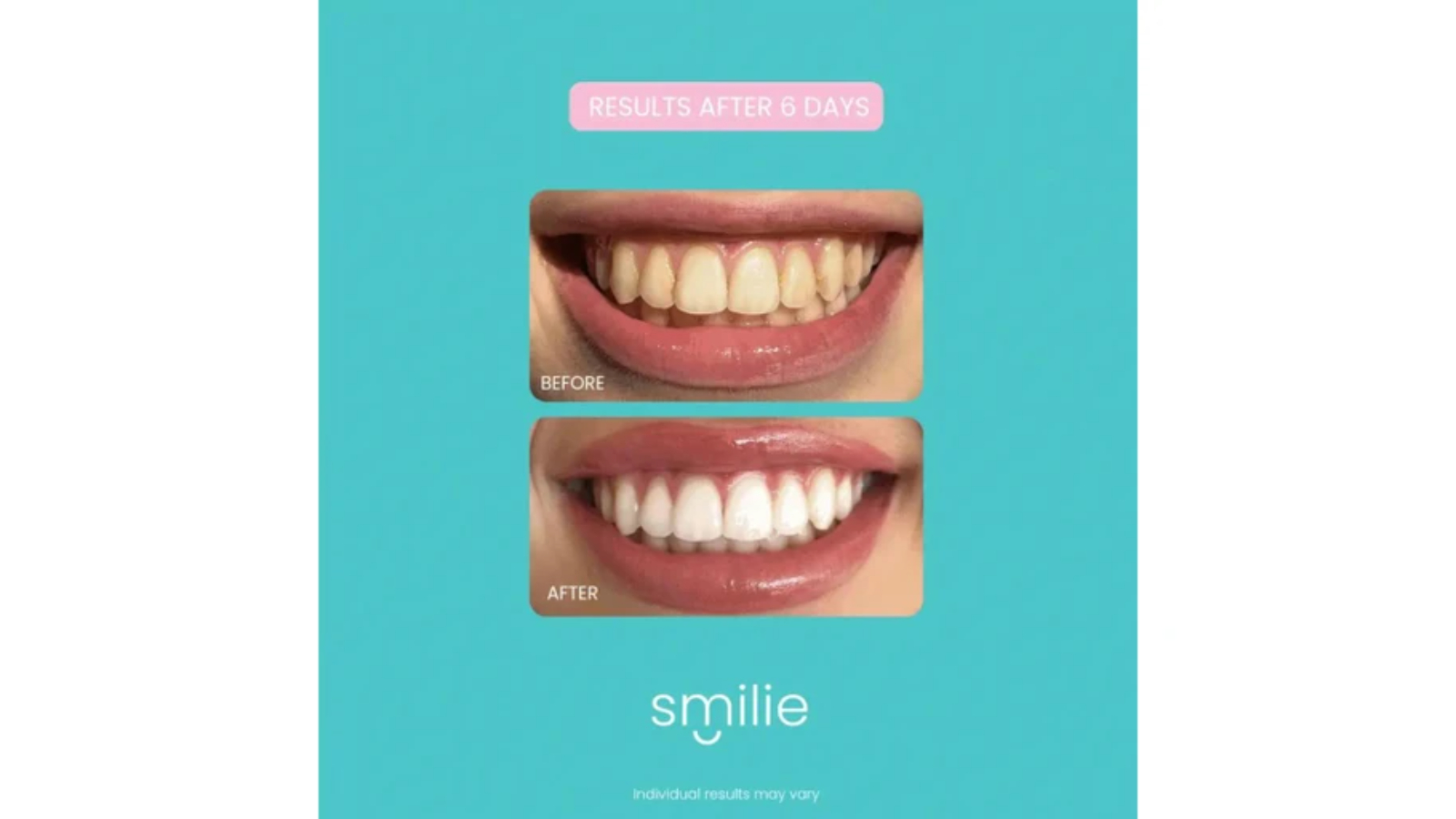 Smilie 2 Piece LED Device Boost Teeth Whitening Gel Kit - Pack of